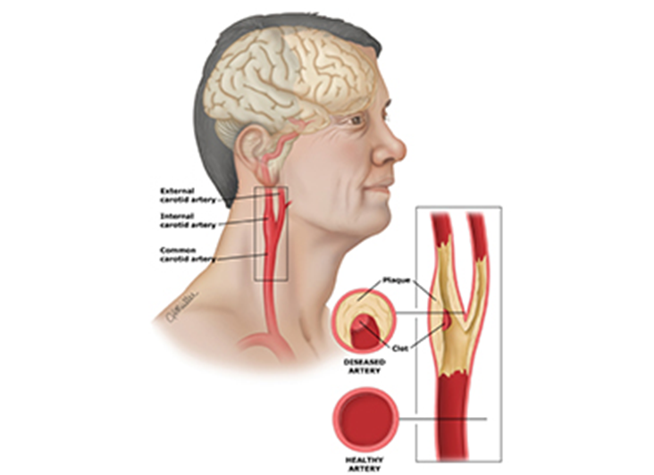 脑动脉粥样硬化