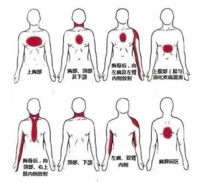 冠状动脉支架植入术